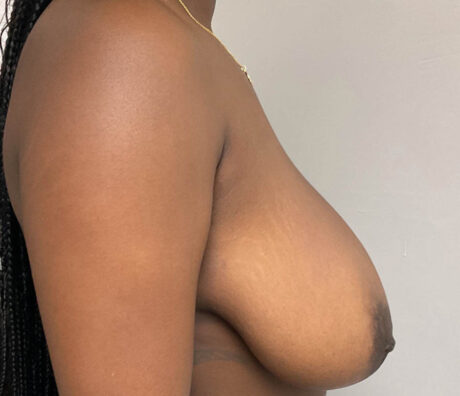 Breast Reconstruction case #5761