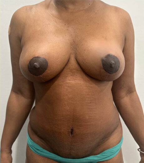 Mommy Makeover case #5703