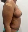 Mommy Makeover case #5703