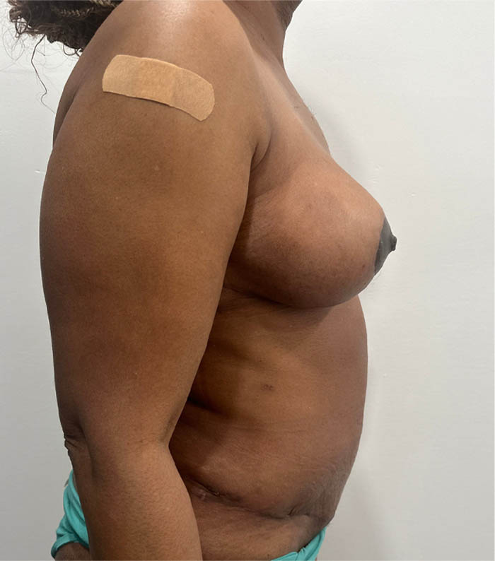 Mommy Makeover case #5703
