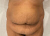 Tummy Tuck case #5581