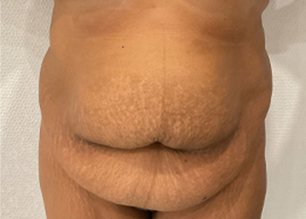 Tummy Tuck case #5581