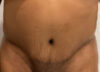 Tummy Tuck case #5581