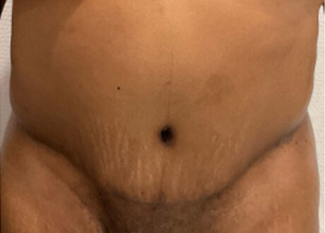 Tummy Tuck case #5581