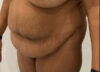 Tummy Tuck case #5581