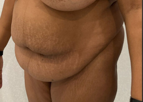 Tummy Tuck case #5581