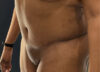 Tummy Tuck case #5581