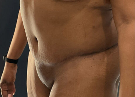 Tummy Tuck case #5581