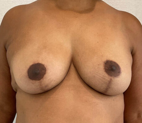 Breast Reduction case #5758