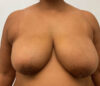 Breast Reduction case #5758