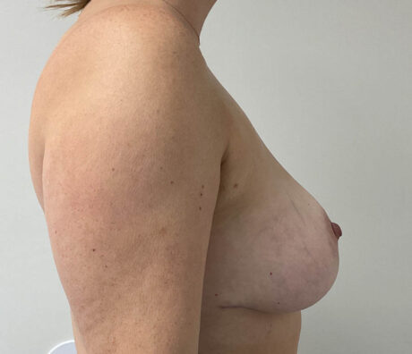 Breast Reduction case #5775