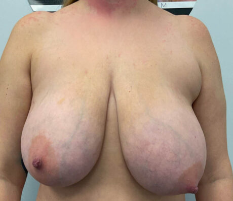 Breast Reduction case #5775