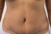 Tummy Tuck case #5722