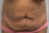 Tummy Tuck case #5722