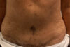 Tummy Tuck case #5714