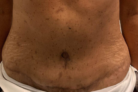 Tummy Tuck case #5714
