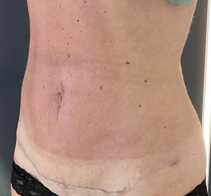 Liposuction case #5955