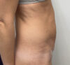 Liposuction case #5955