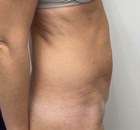 Liposuction case #5955