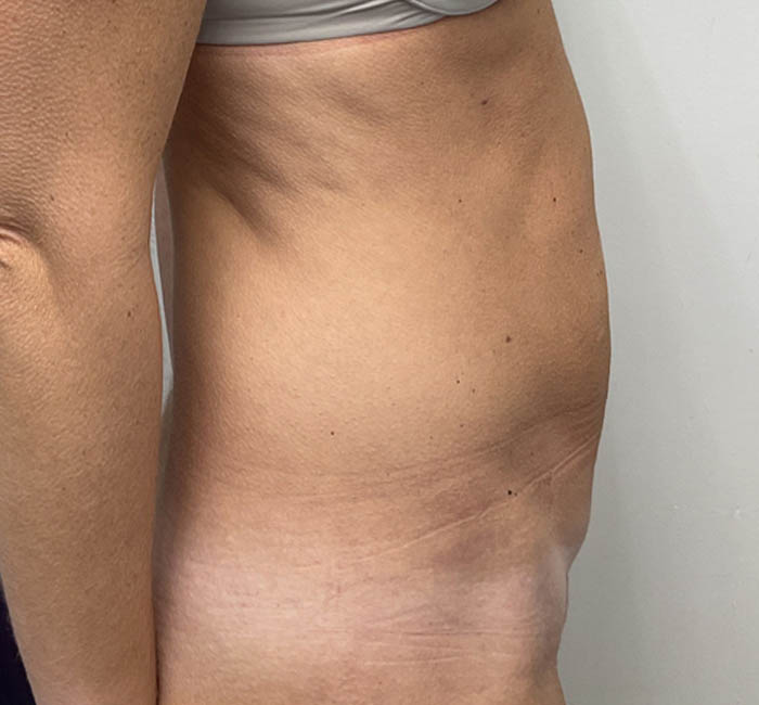 Liposuction case #5955