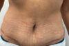 Tummy Tuck case #5677