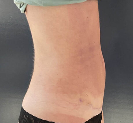 Liposuction case #5955