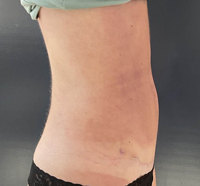 Liposuction case #5955