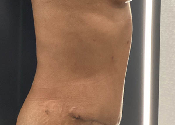 Tummy Tuck case #5896