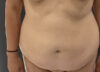 Tummy Tuck case #5903