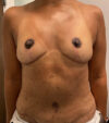 Mommy Makeover case #5690