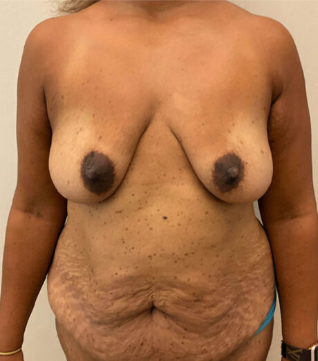 Mommy Makeover case #5690