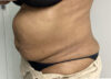 Tummy Tuck case #5544
