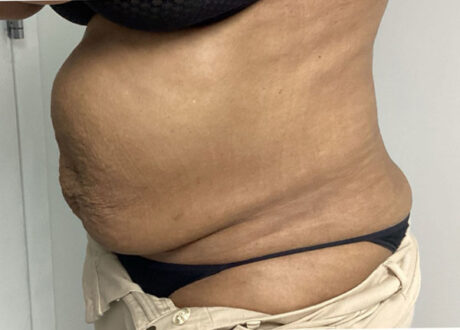 Tummy Tuck case #5544