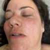 Scar/Skin Discoloration & Stretch Marks case #10180