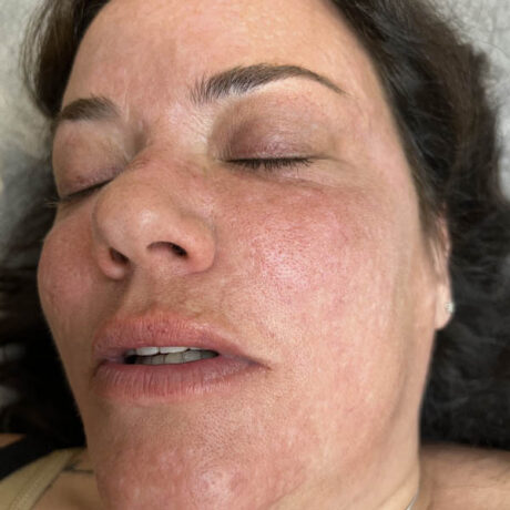 Scar/Skin Discoloration & Stretch Marks case #10180