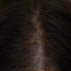 Scalp Micropigmentation case #10063