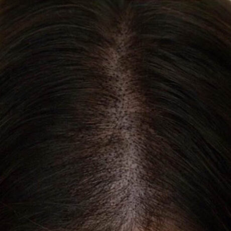 Scalp Micropigmentation case #10063
