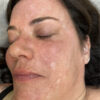 Scar/Skin Discoloration & Stretch Marks case #10180