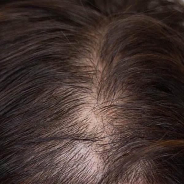 Scalp Micropigmentation case #10063