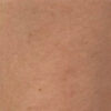 Scar/Skin Discoloration & Stretch Marks case #10177