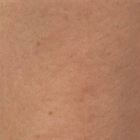 Scar/Skin Discoloration & Stretch Marks case #10177