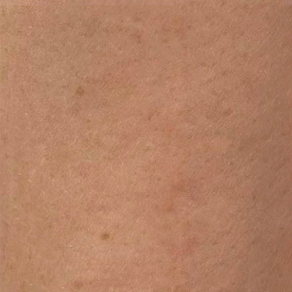Scar/Skin Discoloration case #10177