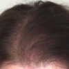 Scalp Micropigmentation case #10067