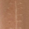 Scar/Skin Discoloration & Stretch Marks case #10177
