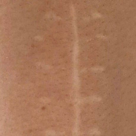 Scar/Skin Discoloration & Stretch Marks case #10177
