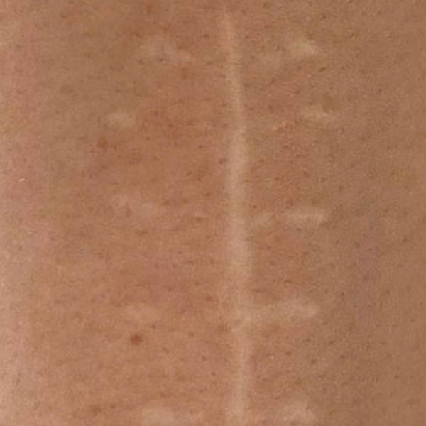 Scar/Skin Discoloration case #10177