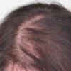 Scalp Micropigmentation case #10067