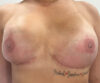 Nipple-Areola Complex (NAC) case #10109