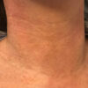 Scar/Skin Discoloration & Stretch Marks case #10174