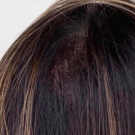 Scalp Micropigmentation case #10070